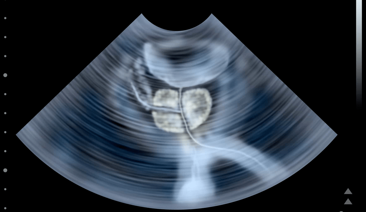 Ultrasound examination of chalcolithic prostatitis